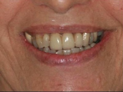 smiling patient