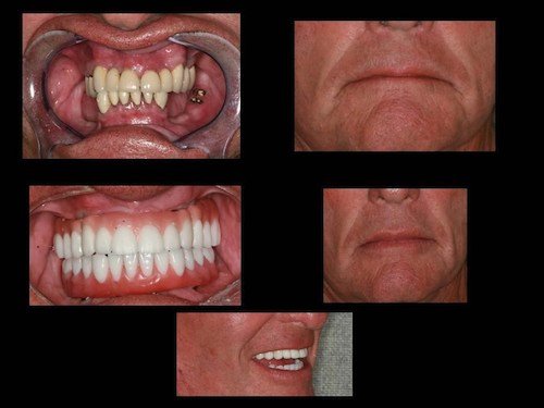 smiling patient